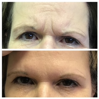 The forehead and crows feet were treated with Botox and the lips with Juvederm Ultra. The forehead and crows feet were treated with Botox and the lips with Juvederm Ultra.