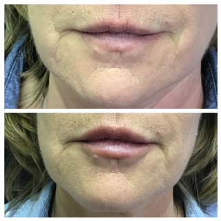 The forehead and crows feet were treated with Botox and the lips with Juvederm Ultra. The forehead and crows feet were treated with Botox and the lips with Juvederm Ultra.
